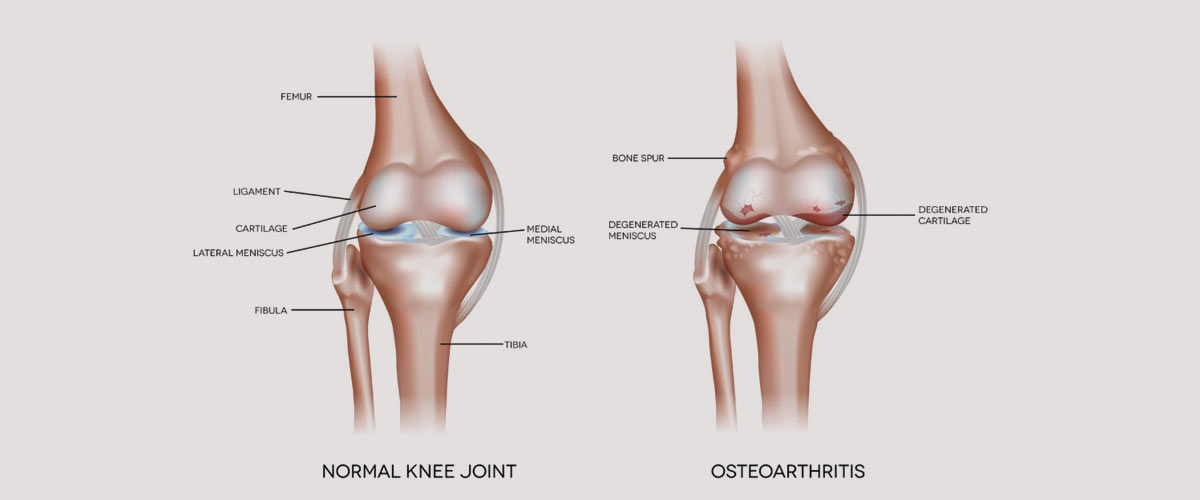 Knee Pain Treatment in Ayurveda